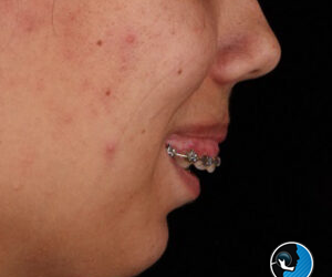 نقص مادرزادی فک