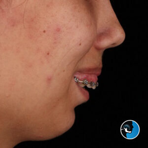 نقص مادرزادی فک