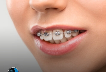 نقش ارتودنسی قبل و بعد از جراحی فک