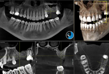 نقش فناوری تصویربرداری پیشرفته (CT، CBCT) در برنامه‌ریزی جراحی فک