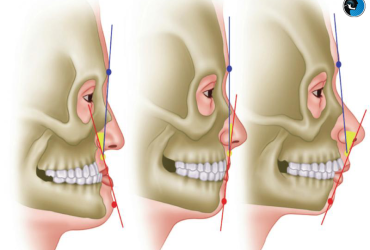 رویکردهای جدید در پیشگیری از عود یا شکست بعد از جراحی فک