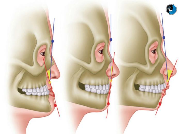 رویکردهای جدید در پیشگیری از عود یا شکست بعد از جراحی فک