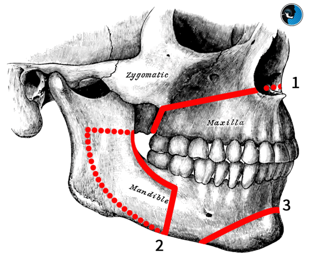 آیا جراحی فک درد دارد؟